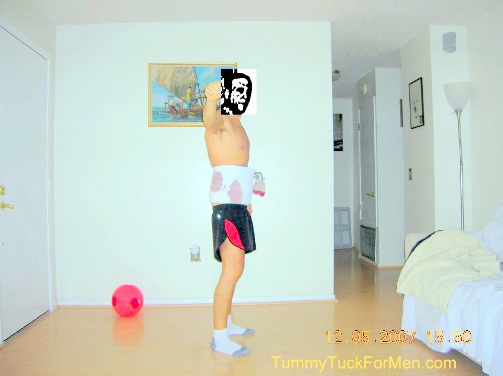 TUMMY TUCK, BODY LIFT