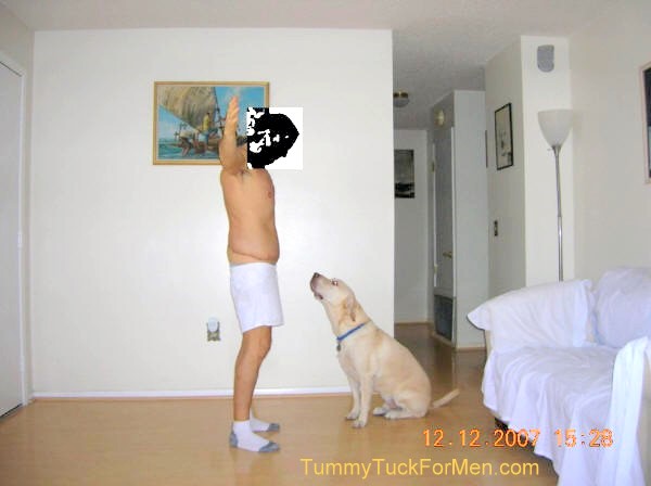 Zoomable "Before" photograph of Tummy Tuck (Abdominoplasty) & Lateral Thigh Lift Surgery to remove sagging skin after a 150 pound weight loss. Tummy Tuck before and after picture gallery. Note the scars and swelling one week after surgery. tummytuckformen.com