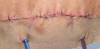 Tummy Tuck Sutures; Tummy Tuck Stitches; Abdominoplasty Sutures; Abdominoplasty Stitches; Surgical Stitches, Surgical Sutures