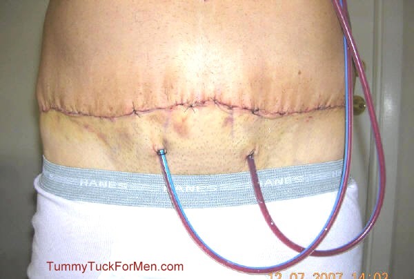 Close-up of Surgical Drain Tubes entering my body. Drain tubes are stitched at point of body entry. tummytuckformen.com