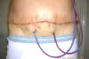 Surgical Drains - Day After Abdominoplasty Plastic Surgery showing surgical drain tubing body locations. tummytuckformen.com