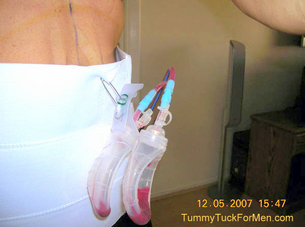 Tummy Tuck Surgical Drains. tummytuckformen.com