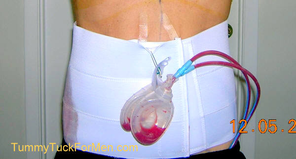 Tummy Tuck Surgical Drains. tummytuckformen.com