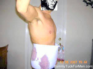 Tummy Tucks Gone Wrong; Bad Tummy Tucks