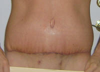 Tummy Tuck Healing After 17 Days