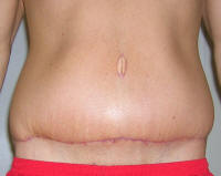 Tummy Tuck Healing After 1 Month And 1 Week