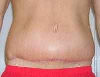 Tummy Tuck Healing After 1 Month And 3 Weeks