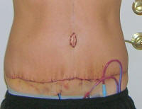 Tummy Tuck Healing After 2 Days