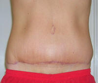 Tummy Tuck Healing After 2 Months