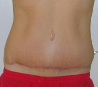 Tummy Tuck Healing After 2 Months And 2 Weeks