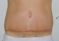 Tummy Tuck Healing After 2 Weeks