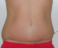 Tummy Tuck Healing After 3 Months And 2 Weeks