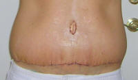 Tummy Tuck Healing After 7 Days