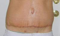 Tummy Tuck Scars After 10 Days