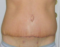Tummy Tuck Scars After 12 Days