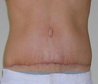 Tummy Tuck Scars After 18 Days