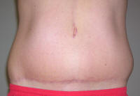 Tummy Tuck Scars After 19 Days