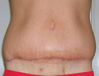 Tummy Tuck Scars After 1 Month