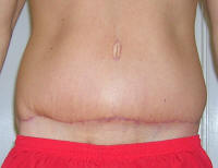 Tummy Tuck Scars After 1 Month And 2 Weeks