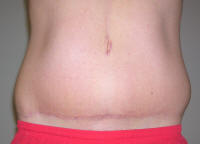 Tummy Tuck Scar Photos, Tummy Tuck Scars After 1 Year