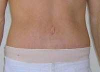 Tummy Tuck Scars After 23 Days