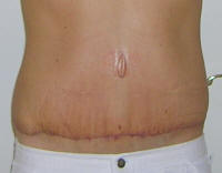 Tummy Tuck Scar Photos, Tummy Tuck Scars After 24 Days