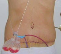 Tummy Tuck Scars After 4 Days
