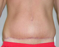 Tummy Tuck Scars After 5 Months