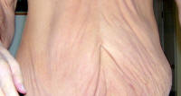 Tummy Tuck Scars Before Picture