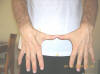 Muscle Atrophy and Weakness in Hand and Fingers Due to Pinched Ulnar Nerve