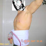 Tummy Tuck For Men; Abdominoplasty For Men