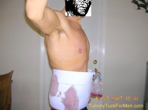 I wrote tummy tuck for men to show you what you go through when you get a tummy tuck.