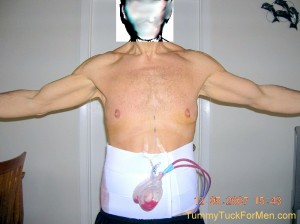 The "TUMMY TUCK HORROR" for me was the Cost, Everything Else Went Pretty Well