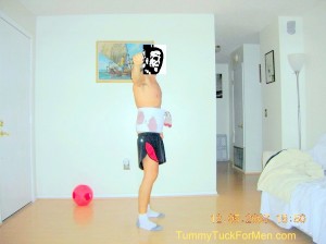 Day After Tummy Tuck Surgery - Tummy Tuck For Men