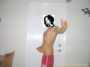 Are you a good tummy tuck candidate? Losing over 150 pounds leaves you with excess belly skin. 